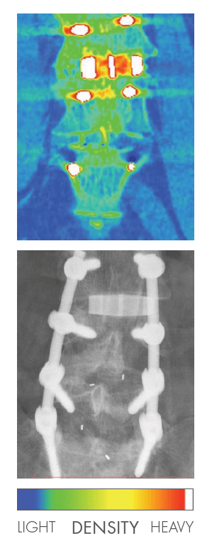 implant spine front view