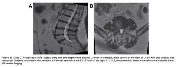 Preoperative spinal stenosis