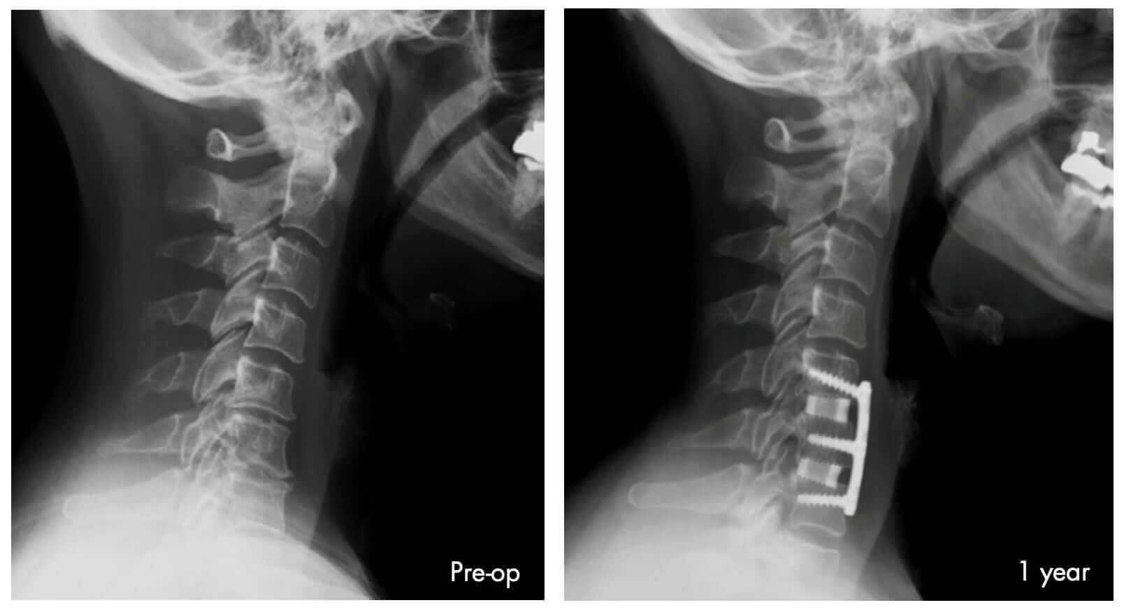 Two Level Acdf Using Silicon Nitride Si3n4 Implants Review Sintx 