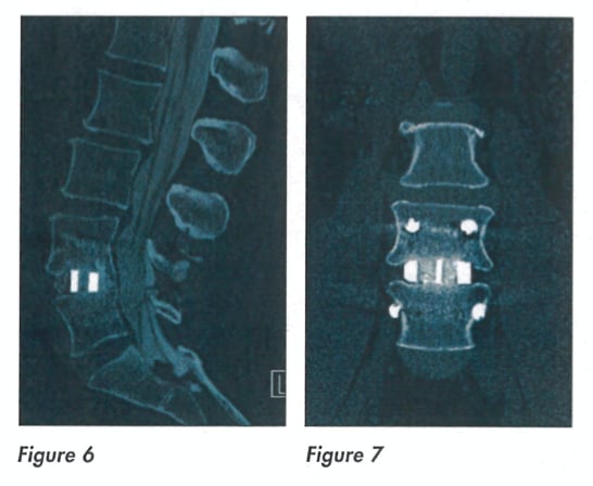 silicon nitride spinal implant post surgery radiograph
