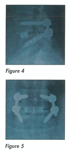 silicon nitride spinal implant post surgery radiograph